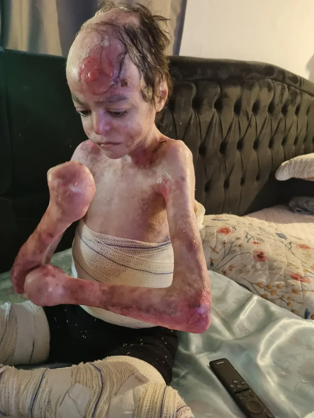 Pedrinho em casa, com as pernas enfaixadas