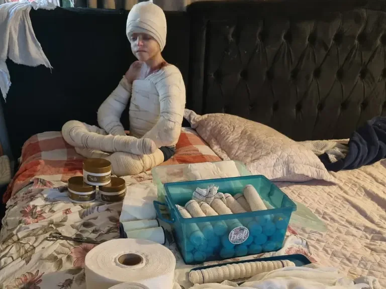 Pedrinho com o corpo enfaixado na cama, ao lado do material de curativo